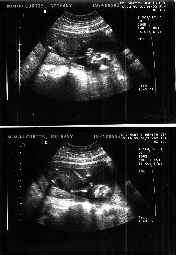 Two Ultrasounds from 26 March - the Les Misearbles look and the peek-a-boo eye